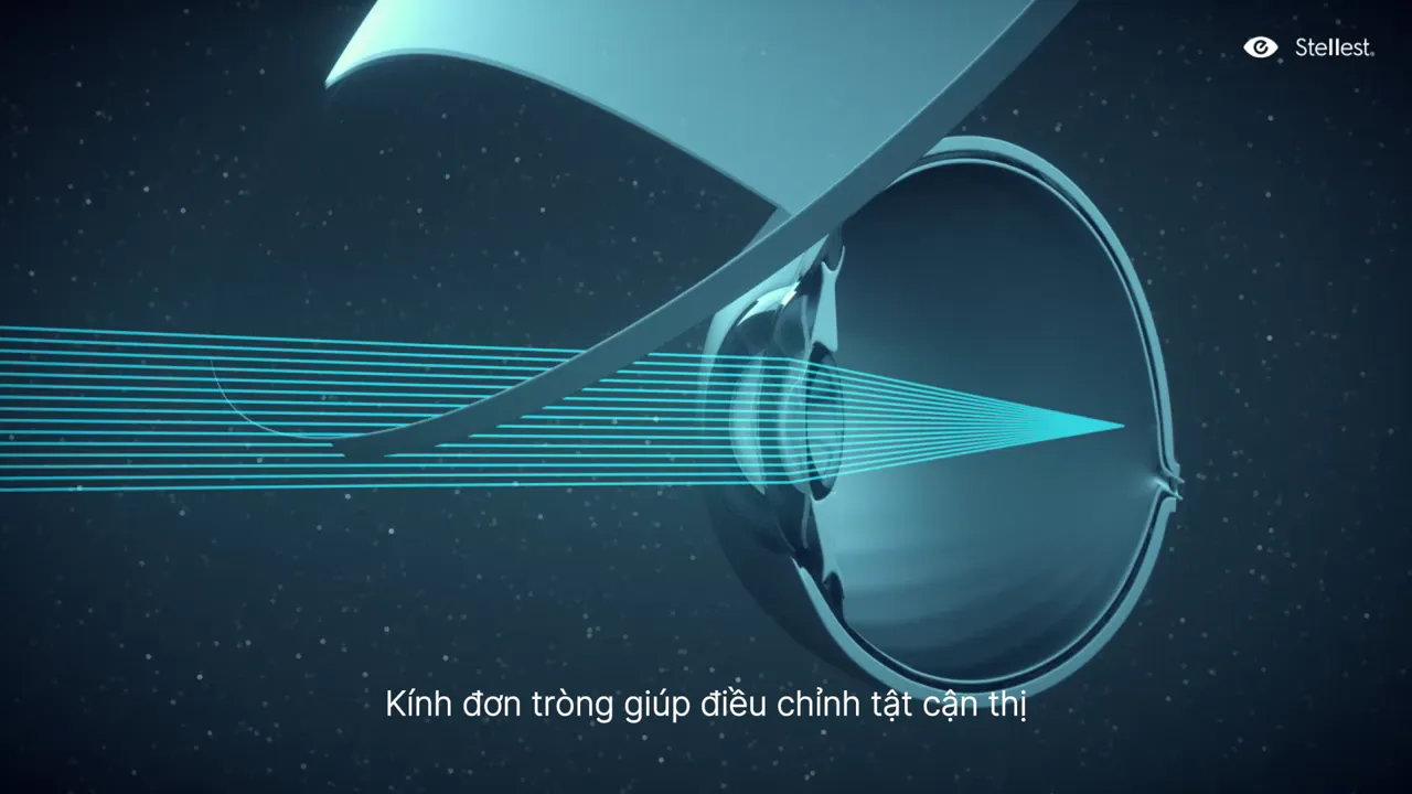 Mắt trẻ em: cận thị tiến triển khi nhãn cầu phát triển quá mức bình thường