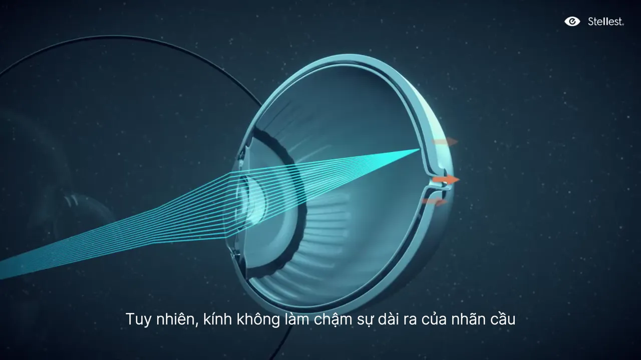Kính thường giúp nhìn rõ nhưng không làm chậm sự dài ra của nhãn cầu