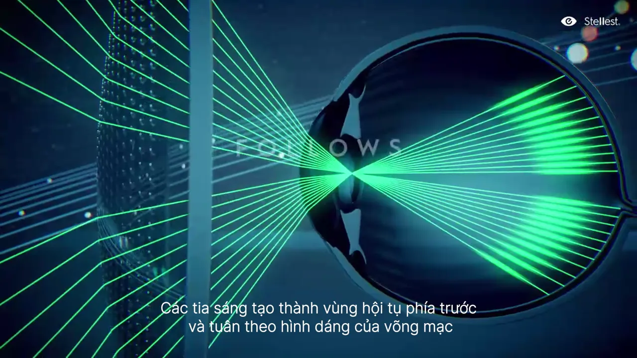 Các tia sáng tạo thành vùng hội tụ phía trước võng mạc và tuân theo hình dáng võng mạc