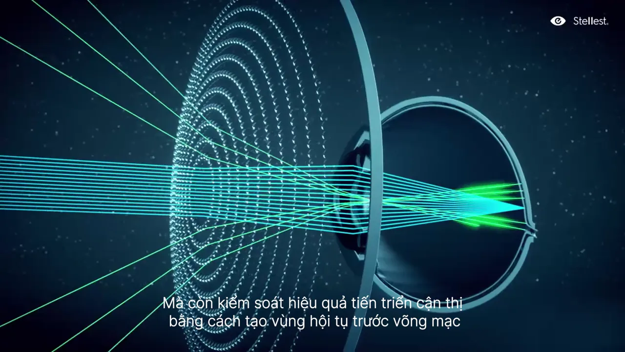 Tác dụng kép: điều chỉnh và kiểm soát độ cận, duy trì trên mọi hướng liếc mắt